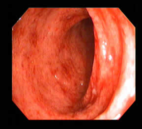 Amoebic Colitis — 2/2