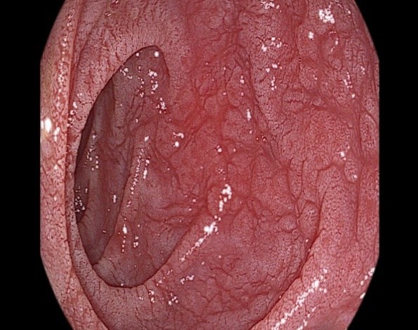 Coeliac Disease