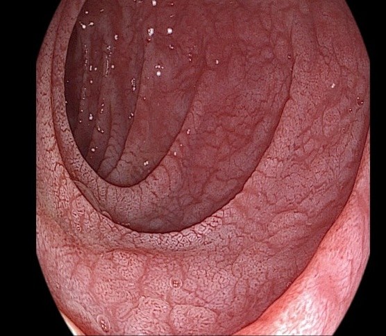 Coeliac Disease