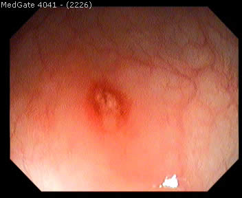 Crohn's Disease — 2/5