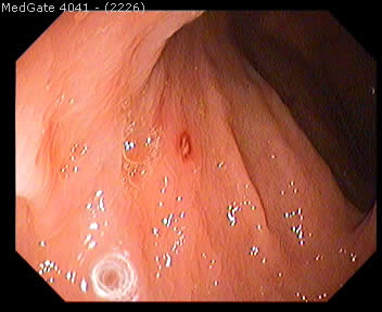 Crohn's Disease — 3/5