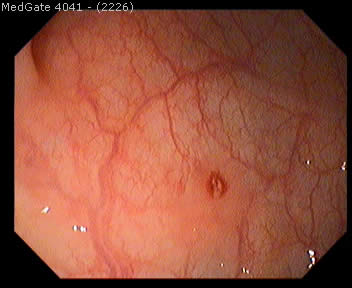 Crohn's Disease — 4/5