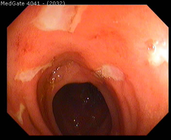 Crohn's Disease — 5/5