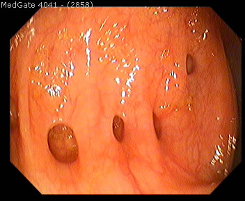 Diverticular Disease — 10/13
