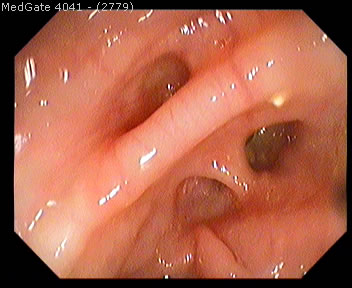 Diverticular Disease — 11/13