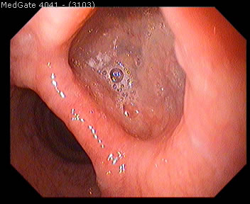 Diverticular Disease — 12/13