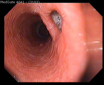 Diverticular Disease — 13/13