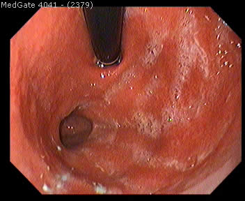 Diverticular Disease — 2/13