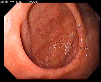 Diverticular Disease — 3/13