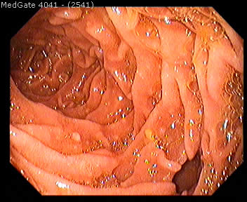 Diverticular Disease — 6/13