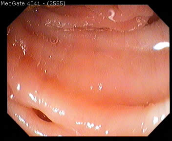 Diverticular Disease — 7/13