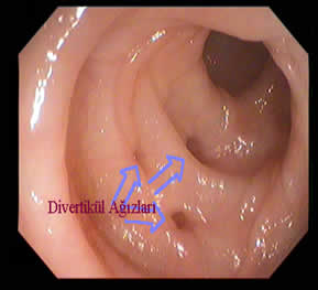 Diverticular Disease — 8/13