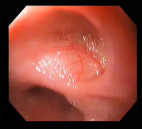 Diverticular Disease — 9/13