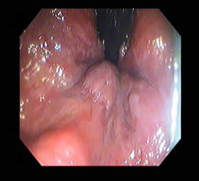Hemoroid (Basur) — 2/4