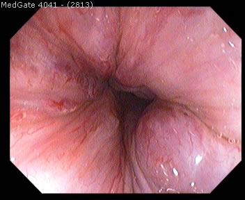 Hemoroid (Basur) — 3/4