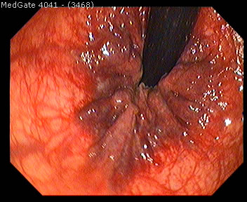 Hemoroid (Basur) — 4/4