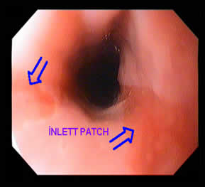 İnlett Patch — 2/3