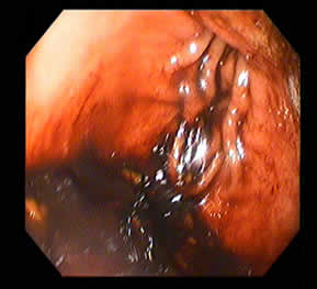 Bleeding from the Stomach
