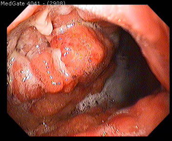 Mide Kanseri — 5/6