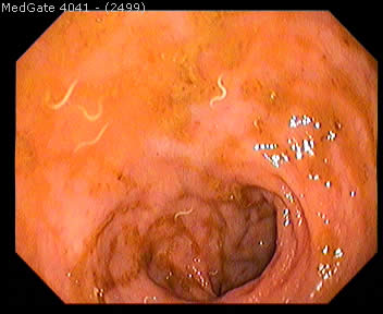 Threadworm (Pinworm) — 2/2