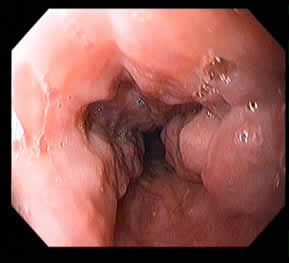 Oesophageal Varices