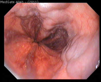 Oesophageal Varices