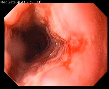 Pill Oesophagitis (oesophagitis caused by drugs) — 2/2