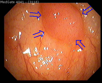Polyps