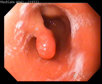 Polyps