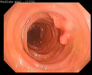 Polyps