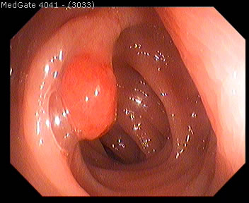 Polyps
