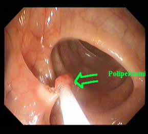 Removing Polyps — 1/2