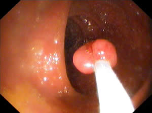 Removing Polyps — 2/2