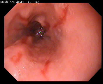Reflux Disease