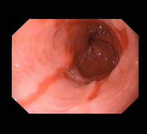 Reflux Disease