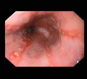 Reflux Disease