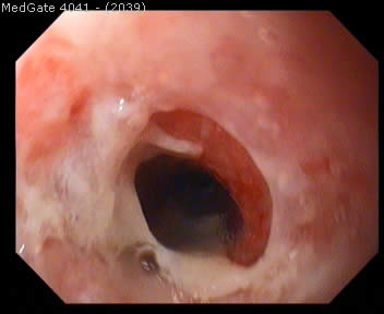 Reflux Disease