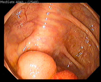 Submucosal Tumours — 2/5