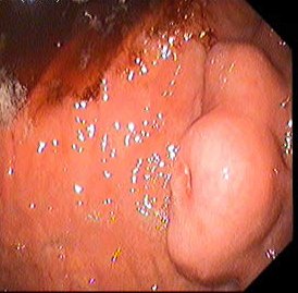Submucosal Tumours — 3/5