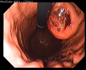 Submucosal Tumours — 4/5