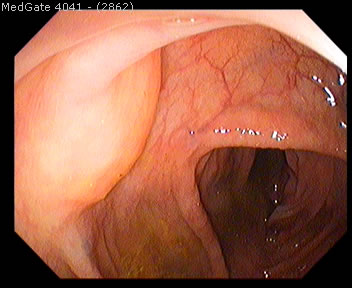 Submucosal Tumours — 5/5