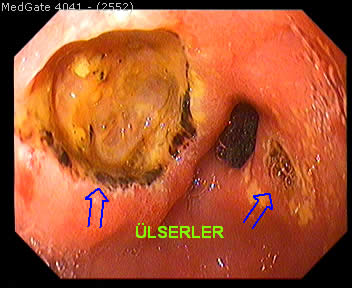 Ülser — 7/7
