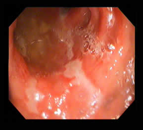 Ulcerative Colitis
