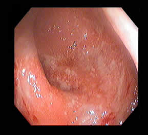 Ulcerative Colitis