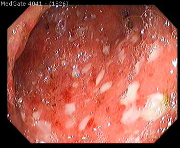 Ulcerative Colitis