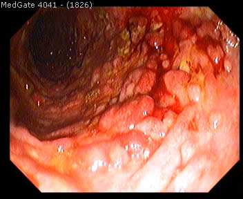 Ulcerative Colitis