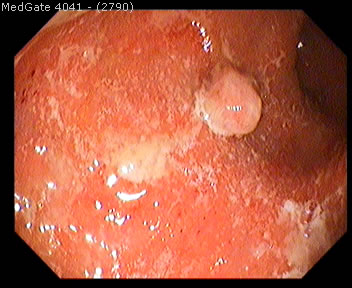 Ulcerative Colitis